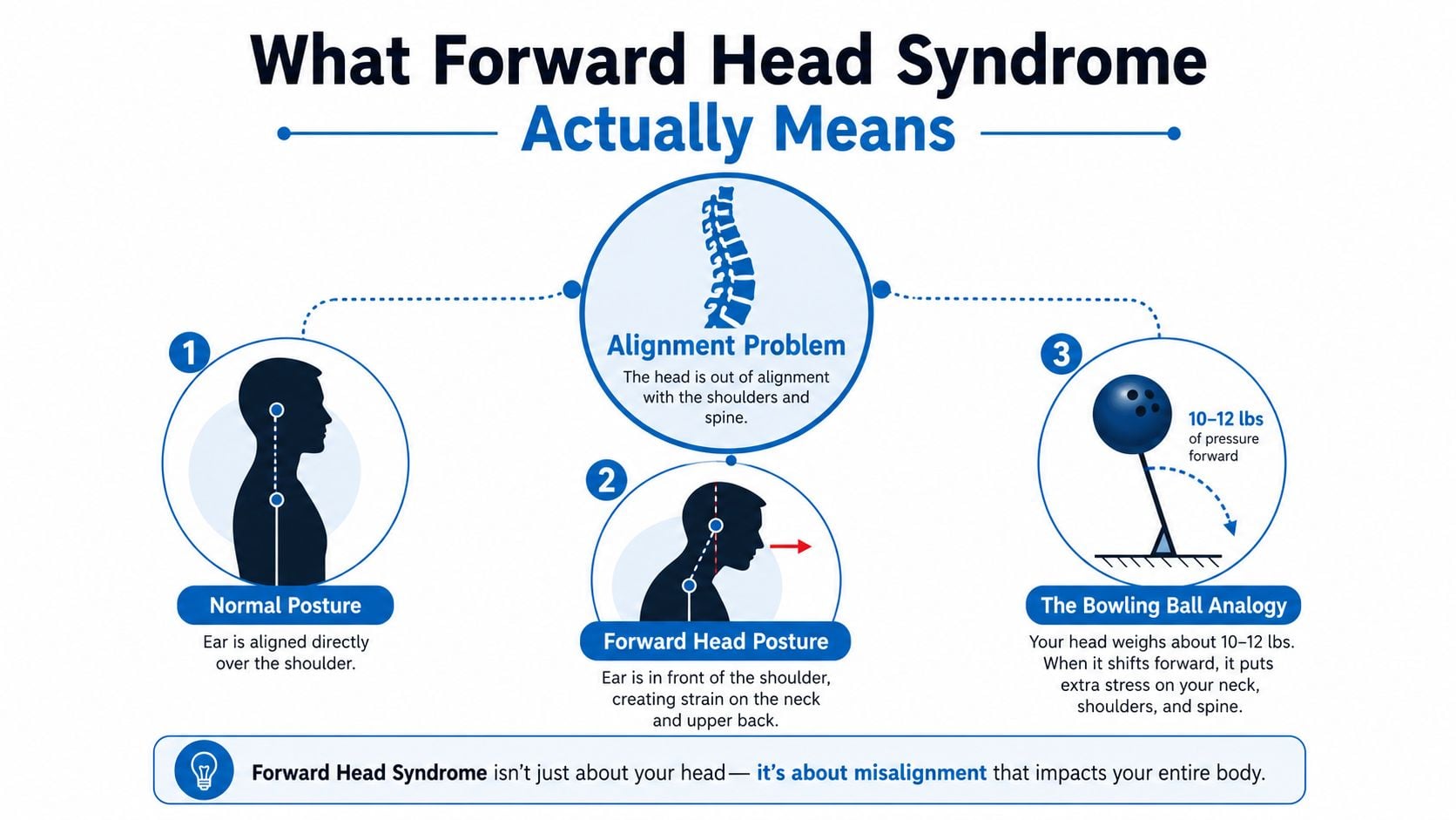 An infographic illustrating forward head syndrome, comparing normal posture with misaligned neck posture and the bowling ball analogy.