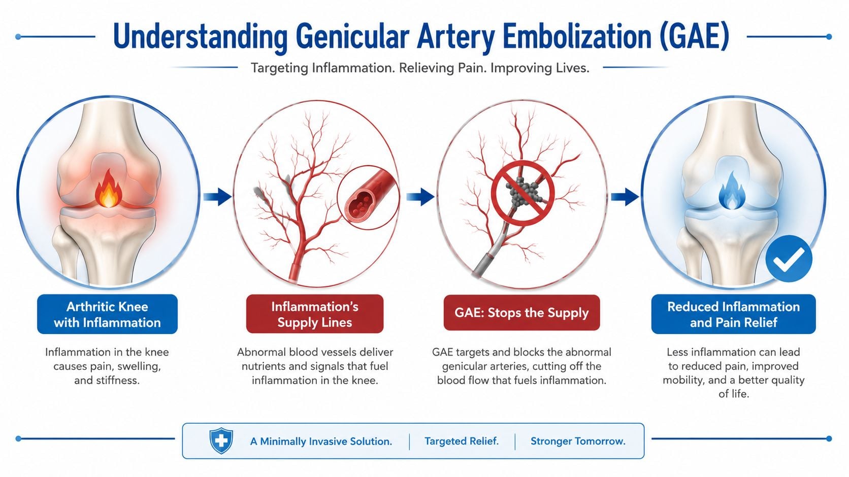 A diagram illustrating the Genicular Artery Embolization procedure to treat knee inflammation and pain.
