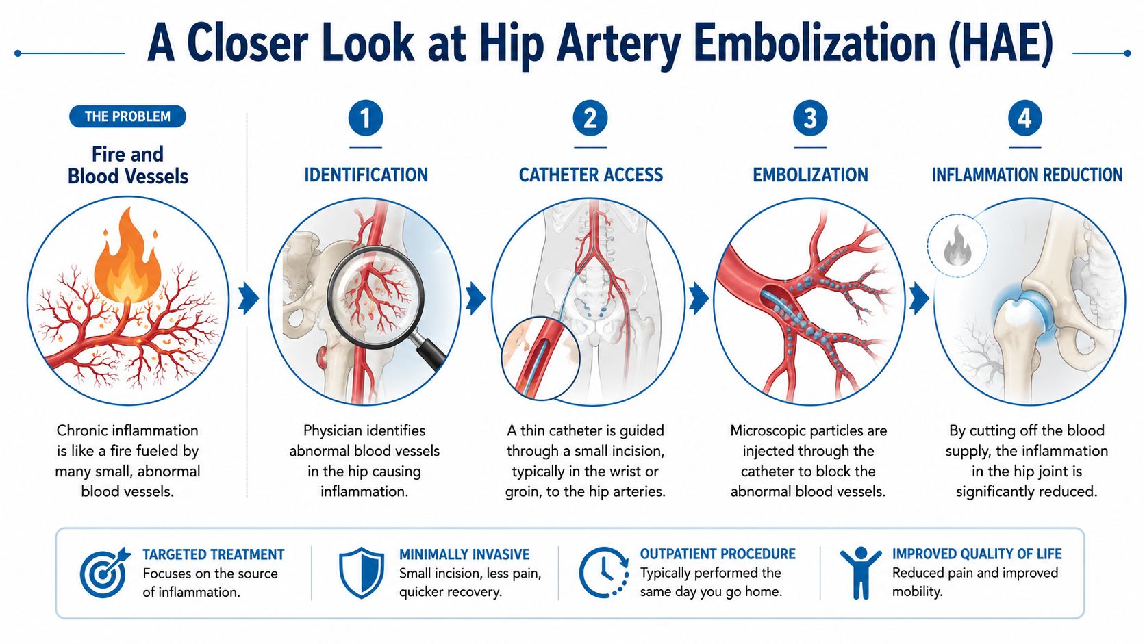 An infographic detailing the four steps of the Hip Artery Embolization medical procedure for treating inflammation.