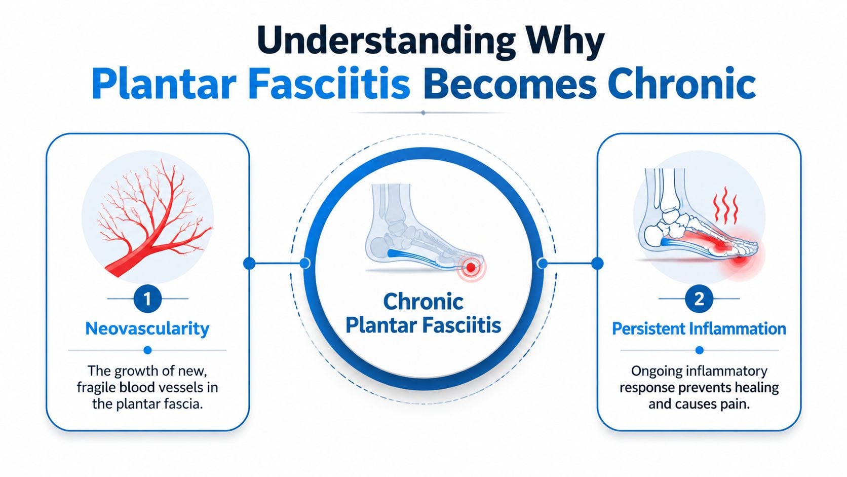 An infographic illustrating why plantar fasciitis becomes chronic due to neovascularity and persistent inflammation in the foot.