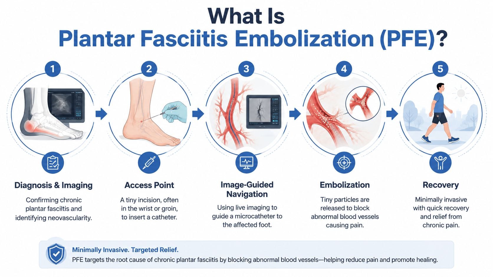A five-step infographic illustrating the medical process of Plantar Fasciitis Embolization for chronic pain relief.