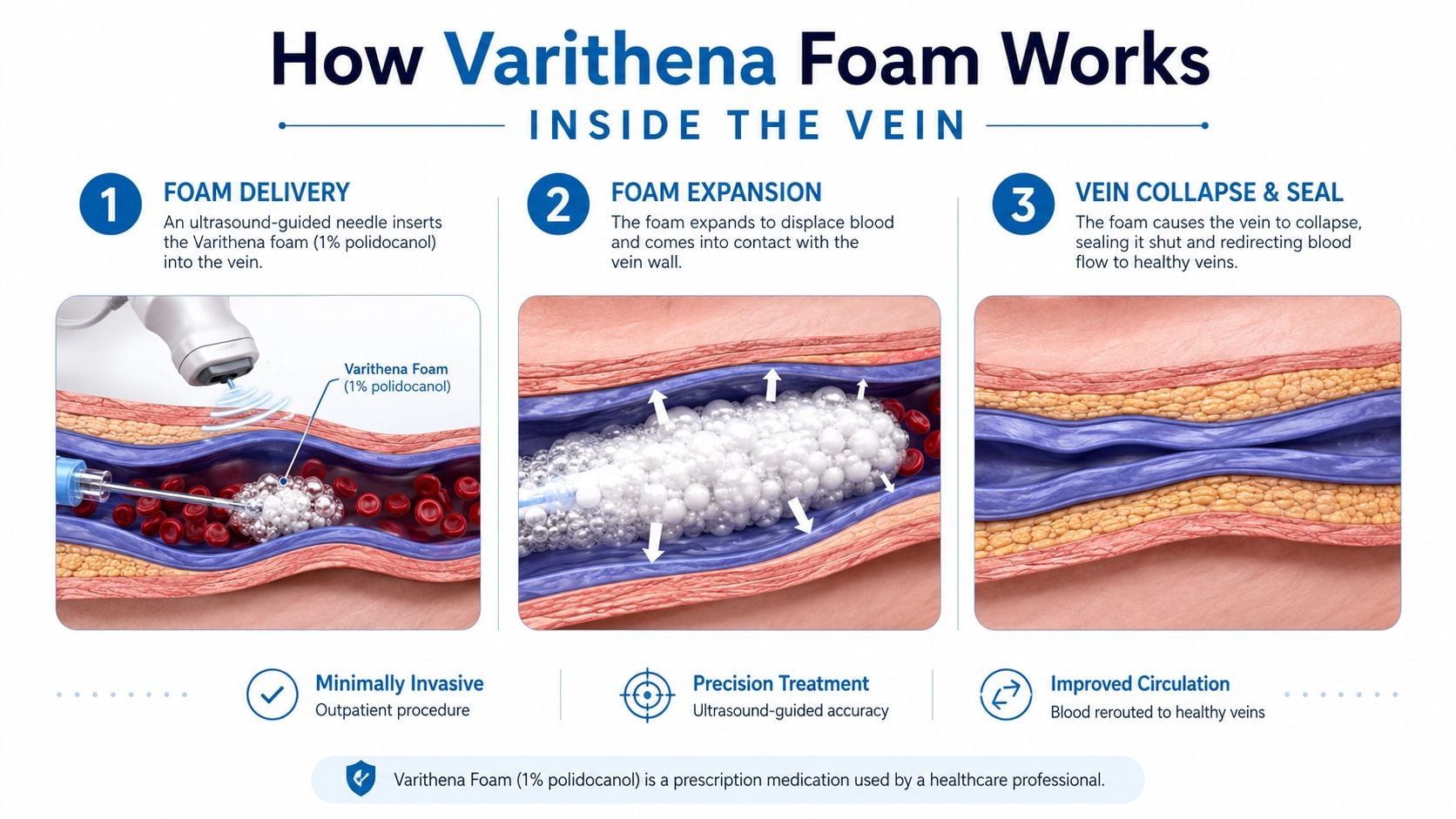 An infographic showing the three-step Varithena foam procedure to treat varicose veins by collapsing and sealing them.