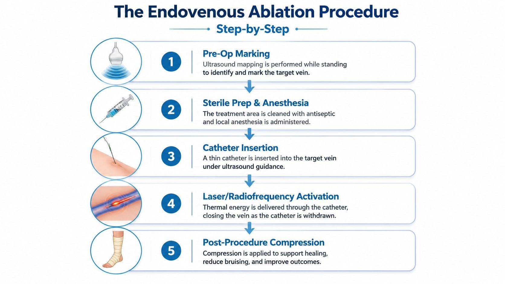 A step-by-step infographic illustrating the five stages of an endovenous ablation procedure for treating varicose veins.