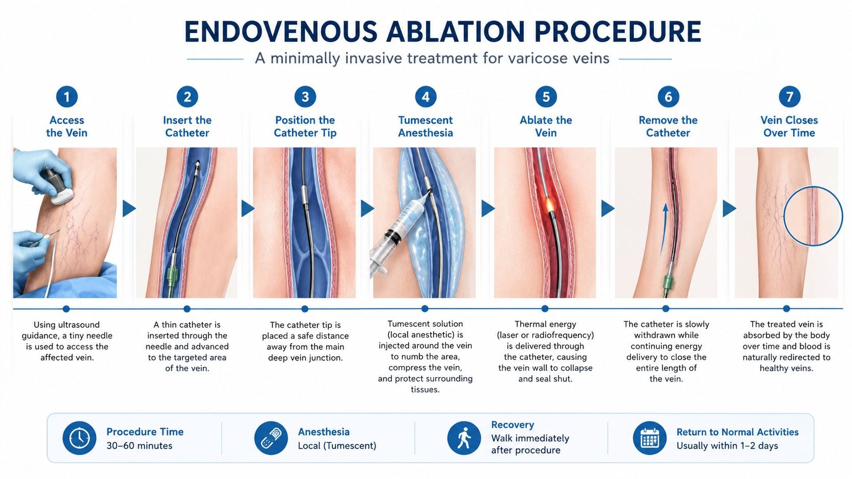 A step-by-step infographic illustrating the endovenous ablation procedure for treating varicose veins using thermal energy.