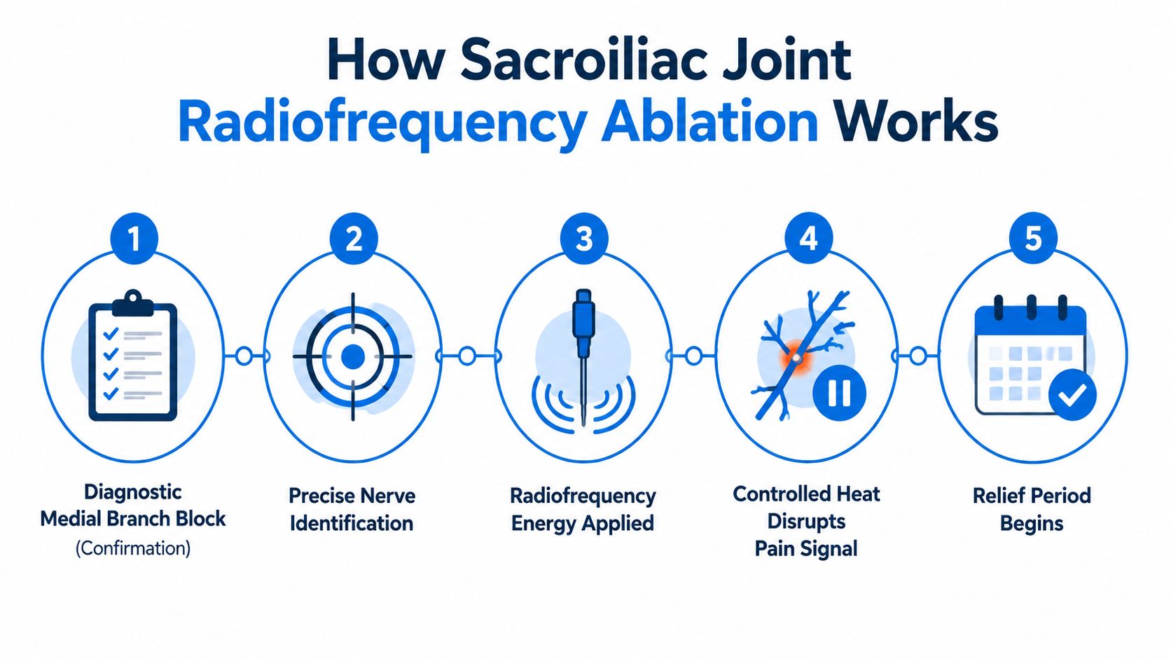 A five-step infographic showing how a sacroiliac joint radiofrequency ablation procedure treats chronic lower back pain.