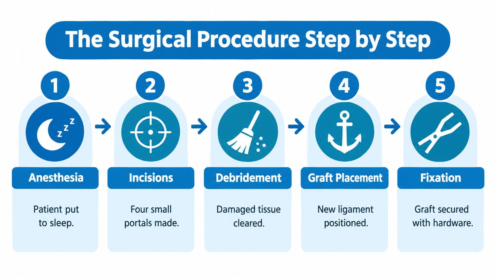 A step-by-step infographic illustrating the five stages of an arthroscopic ACL reconstruction surgical procedure.