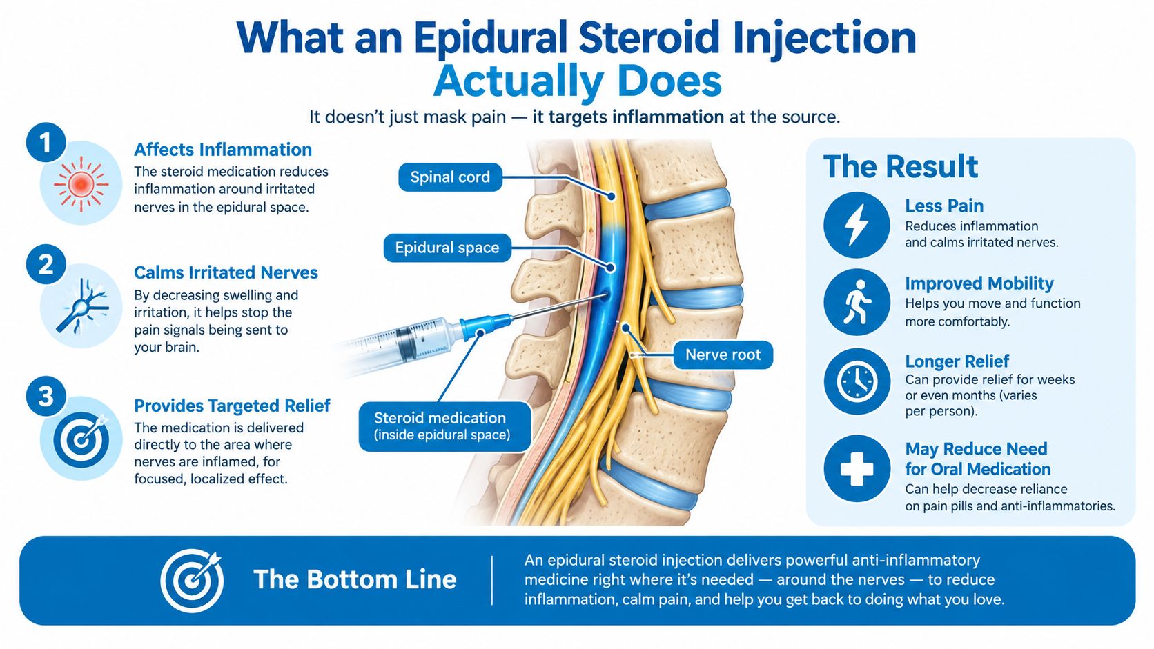 An infographic explaining how an epidural steroid injection targets inflammation in the spinal cord to reduce pain.