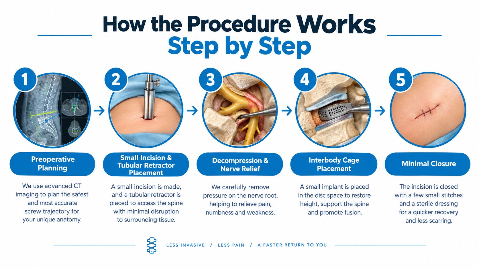 A five-step infographic illustrating the minimally invasive lumbar spinal fusion procedure from planning to final incision closure.