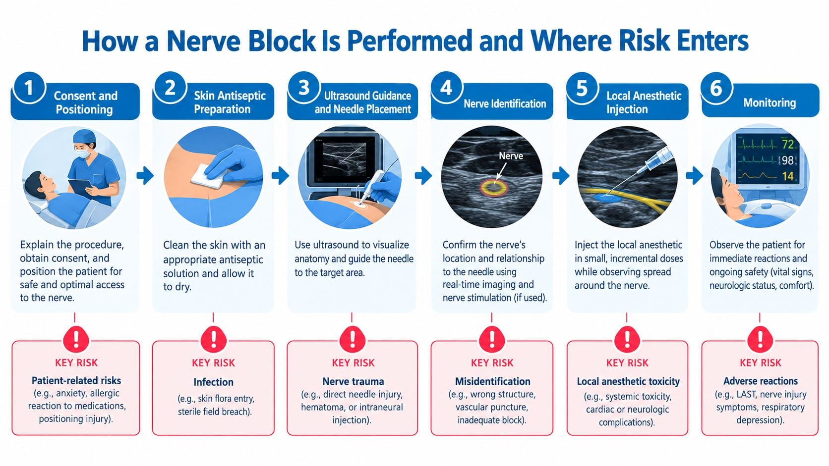 A 6-step infographic illustrating the nerve block procedure and highlighting key medical risks at each stage.